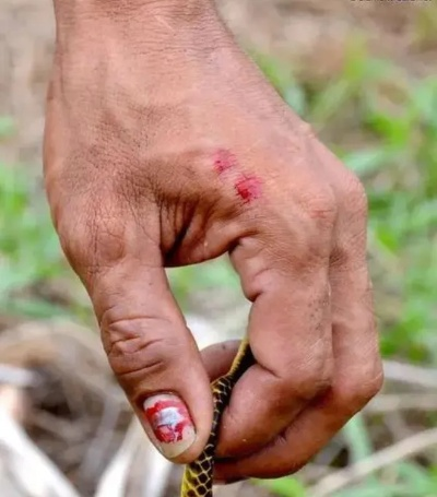 男子养蛇意外截肢，揭秘五步蛇饲养风险与价值